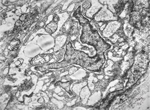 F,12y. | liposarcoma v.s.- orbita